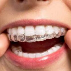 invisible-braces-woodbridge-on-300x257 invisible-braces-woodbridge-on-300x257